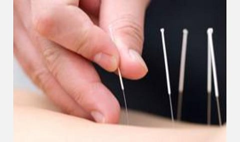 கரோனாவுக்கு அக்குபஞ்சர் சிகிச்சை: மத்திய ஆயுஷ் அமைச்சகத்துக்கு உயர் நீதிமன்றம் உத்தரவு