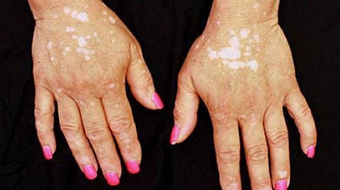 இன்று உலக வெண்புள்ளிகள் தினம்: அறிவியல் உண்மைகளை அரசுகள் வெளியிட கோரிக்கை