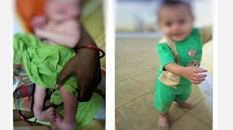 சிகிச்சைக்கு முன் உள்நோக்கி திரும்பிய நிலையில் இருந்த குழந்தையின் பாதம். (அடுத்த படம்) சிகிச்சைக்குப் பின் சீரான நிலையில் குழந்தையின் பாதம்