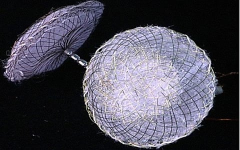 மூளைக்குச் செல்லும் ரத்தத்தின் போக்கை முறைப்படுத்தும் ஸ்டென்ட்: முதன்முறையாக இந்தியாவில் கண்டுபிடிப்பு