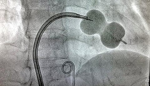 பலூன் சிகிச்சை மூலம் விரிவடையச் செய்யப்படும் இதய வால்வு சுருக்கம்.