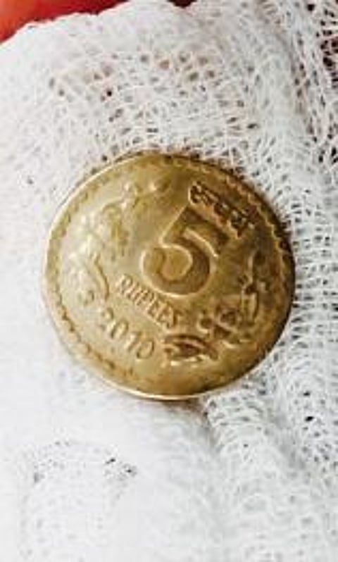 சிறுமி தனுசுயாவுக்கு சிகிச்சை அளித்த மருத்துவக் குழுவினர். அடுத்த படங்கள்: சிறுமி தனுசுயா. உணவு குழாயில் சிக்கியுள்ள நாணயம். கடைசிப்படம்: தனுசுயா விழுங்கிய 5 ரூபாய் நாணயம்.