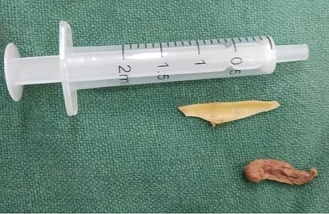 மூதாட்டியின் உணவுக் குழாயில் இருந்து எண்டோஸ்கோப் மூலம் அகற்றப்பட்ட கோழி எலும்பு மற்றும் இறைச்சி.