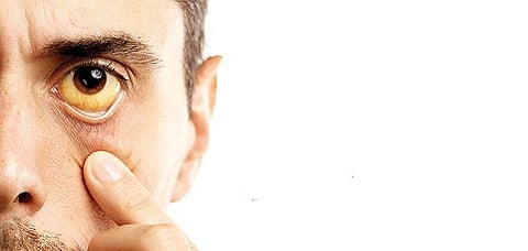 நலம்தானா 06: காமாலைக்கு சிகிச்சை வேண்டாமா?