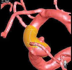 தென்னிந்தியாவிலேயே முதன்முறையாக மதுரை ஹானா ஜோசப் மருத்துவமனையில் ‘சில்க் விஸ்டா’ கருவி மூலம் ரத்த நாள சிகிச்சை: டாக்டர் எம்.ஜே.அருண்குமார் தகவல்