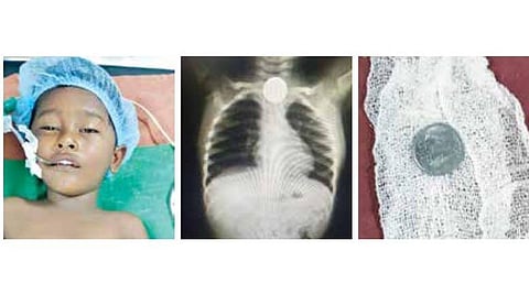 சிறுவன் மிதுன். அடுத்த படம்: எக்ஸ்ரேவில் தொண்டையில் சிக்கிய ஒரு ரூபாய் நாணயம். கடைசிப் படம்: அறுவை சிகிச்சையின்றி அகற்றப்பட்ட ஒரு ரூபாய் நாணயம்.