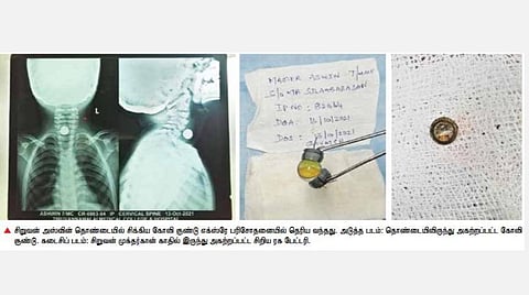 சிறுவன் அஸ்வின் தொண்டையில் சிக்கிய கோலி குண்டு எக்ஸ்ரே பரிசோதனையில் தெரிய வந்தது. அடுத்த படம்: தொண்டையிலிருந்து அகற்றப்பட்ட கோலி குண்டு. கடைசிப் படம்: சிறுவன் முக்தர்கான் காதில் இருந்து அகற்றப்பட்ட சிறிய ரக பேட்டரி.