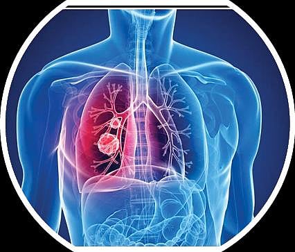 பளிச் பத்து 128: புற்றுநோய்