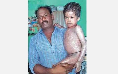 தோல் உரியும் விநோத நோயால் பாதிக்கப்பட்ட திருப்பூர் சிறுவன்: தமிழக அரசின் உதவியை எதிர்நோக்கும் குடும்பத்தினர்