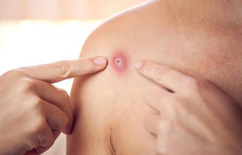 குரங்கு அம்மை நோய்: அறிகுறிகள் முதல் சிகிச்சை வரை - ஒரு விரைவுப் பார்வை