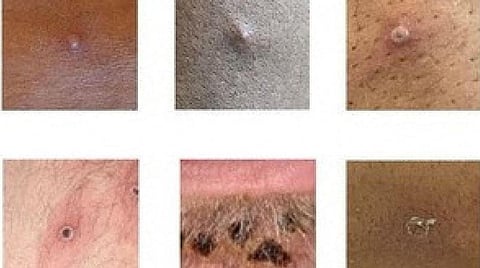 குரங்கு அம்மை நோயை ஒழிக்க ஒருங்கிணைந்த நடவடிக்கைகள் அவசியம்: உலக சுகாதார அமைப்பு