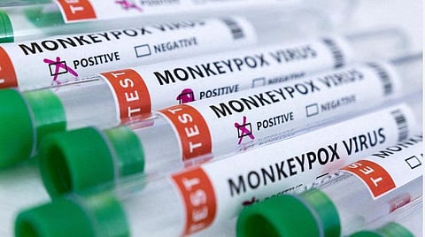 குரங்கம்மையை எதிர்கொள்ளத் தயார்நிலையில் இருக்கிறோமா?