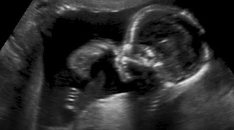 கருவில் இருந்த சிசுவுக்கு மூளை அறுவை சிகிச்சை - அமெரிக்க மருத்துவர்கள் சாதனை