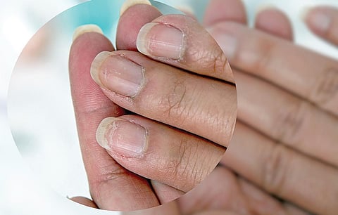 தயங்காமல் கேளுங்கள் - 38: ஸ்பூன் போல் குவிந்த நகம் உள்ளதா?