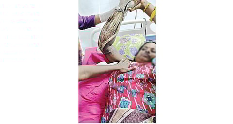 சென்னை ராஜீவ்காந்தி அரசு மருத்துவமனையில் சிகிச்சை பெற்றுவரும் ஜோதி.