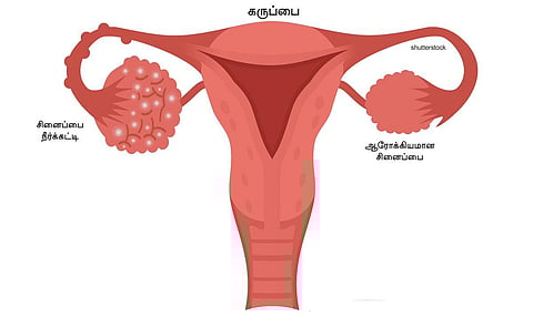 பி.சி.ஓ.டி. பிரச்சினையில் இருந்து விடுபடுவது எப்படி?