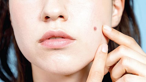 தயங்காமல் கேளுங்கள் - 49: மச்சங்கள் வராமல் தடுக்க முடியுமா?