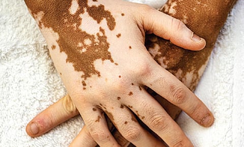 டாக்டர் பதில்கள் 11: வெண்புள்ளிகள் நீங்குமா?