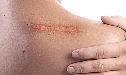 தயங்காமல் கேளுங்கள் - 59: காயம் பட்ட இடத்தில் இயற்கையின், ‘பேச் ஒர்க்’ தழும்பு