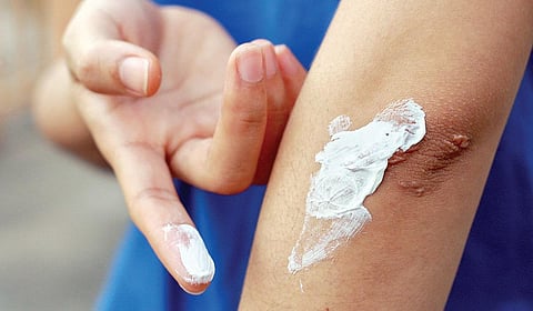 தயங்காமல் கேளுங்கள் - 60: தழும்பு மறைய இதை செய்து பாருங்கள்