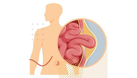 டாக்டர் பதில்கள் 35: குடலிறக்கம் ஏன் ஏற்படுகிறது?