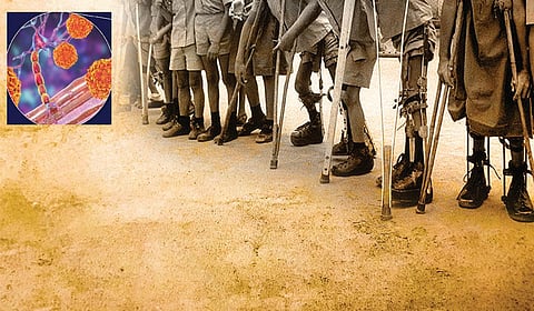 இந்தியாவில் இன்னும் இருக்கிறதா போலியோ?