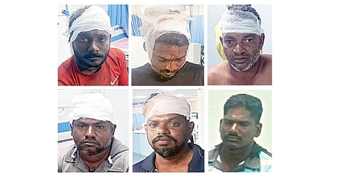 இலங்கை கடற்கொள்ளையர்களின் தாக்குதலில் பலத்த காயமடைந்த மீனவர்கள்.