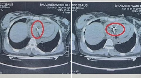 மதுரை: பெண்ணின் இதயம் வரை குத்தியிருந்த ஊசியை பாதுகாப்பாக அகற்றிய மருத்துவர்கள்!