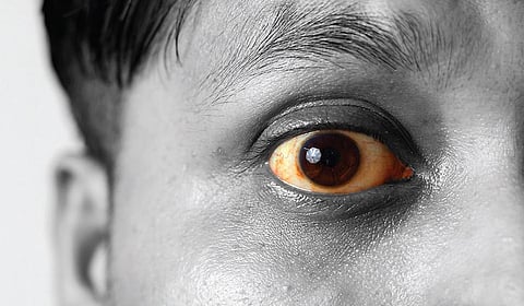 மஞ்சள் காமாலை நோய் அல்ல, அறிகுறி