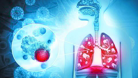 இந்தியாவில் புற்றுநோய் பாதிப்பு 1990 முதல் 26 சதவீதம் அதிகரிப்பு