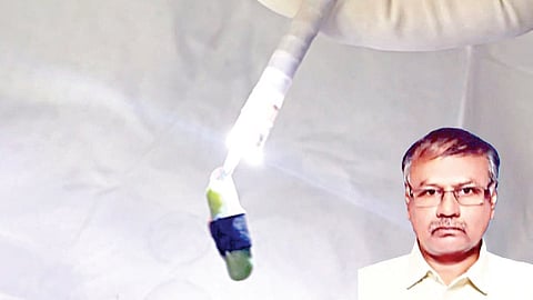 குழந்தையின் சுவாச குழாயில் இருந்து எடுக்கப்பட்ட விசில்.(உள்படம்) எழும்பூர் அரசு குழந்தைகள் மருத்துவமனை இயக்குநர் எஸ்.மதிவாணன்.