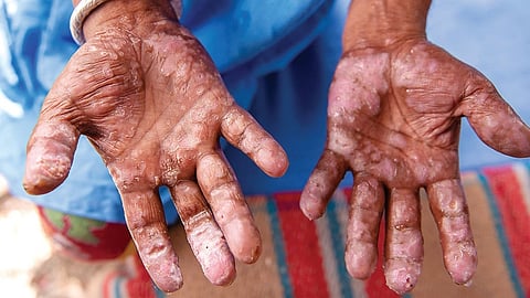 உலக தொழுநோய் நாள்