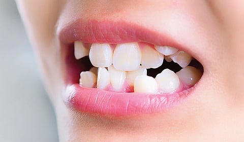 சீரற்ற பல் அமைப்பு: எப்போது கவனம் தேவை?