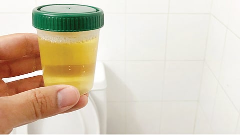 சிறுநீரில் நுரை உணர்த்துவது என்ன? | நலம் வாழ கேள்வி - பதில்