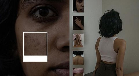 Acne Scars & Body Hair: A Photoseries On What We Gain On Losing Our Insecurities