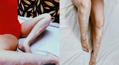 Loving My Skin & Everything Within: Of Living With Vitiligo