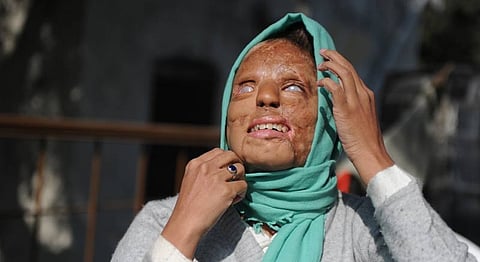 Free Medical Treatment For Acid Attack Survivors In Delhi, Government Promises