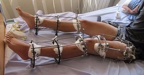 Inside India’s Completely Unregulated Limb-Lengthening Industry