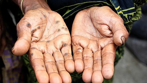 Median excess lifetime cancer risk of 2 per 10,000 from food arsenic exposure in Bihar. (Image: Wikimedia Commons)