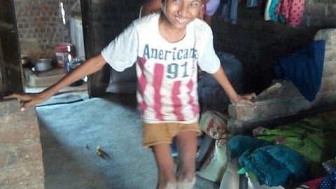 Dilip in Bankpura village, Dhar, MP suffers from skeletal fluorosis (Source: Dalpat & Heena)