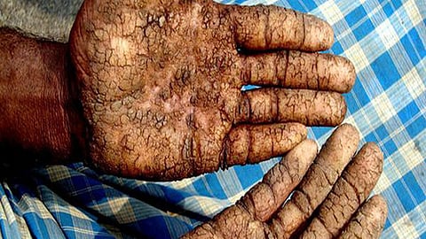 आर्सेनिकोसिस