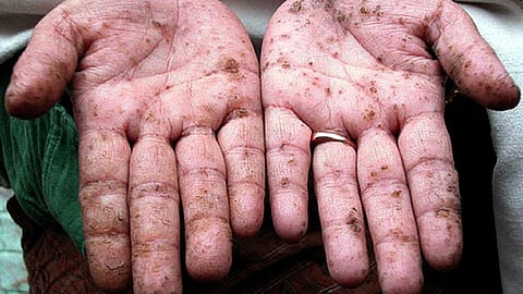 आर्सेनिक समस्या : बढ़ते खतरे