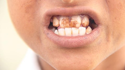 फ्लोराइड की अधिकता से अस्थि विकृति एवं पोषण आहार से सम्बन्ध