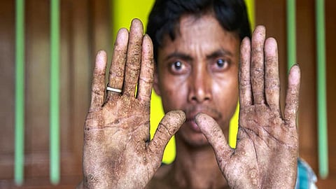 आर्सेनिकग्रस्त मरीज