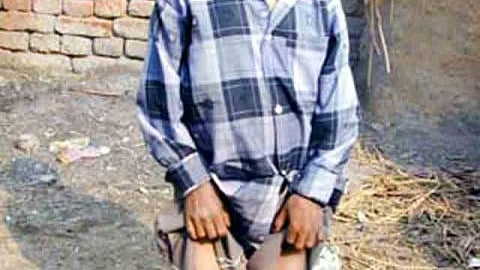 Children suffering from fluoride