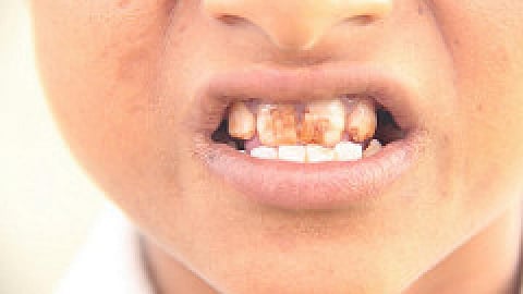 dental fluorosis