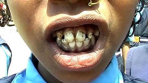 dental fluorosis