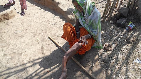 फ्लोरोसिस से पीड़ित कालीबाई