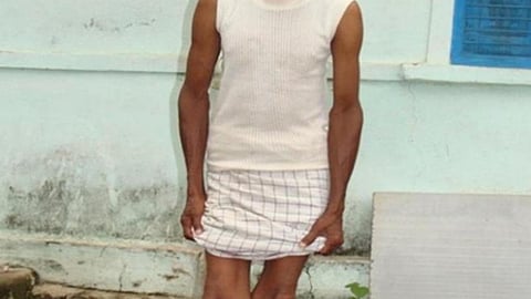 राजस्थान प्रदेश का पहला जेनू- वेल्गम सिंड्रोम केस (Fluoride, Epub 013)