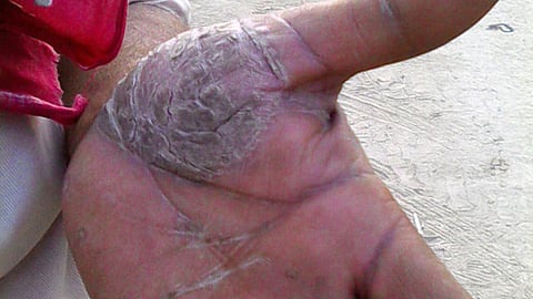 दबंग राघोपुर में कैंसर का कहर, बड़े-बड़ों पर कोई नहीं असर